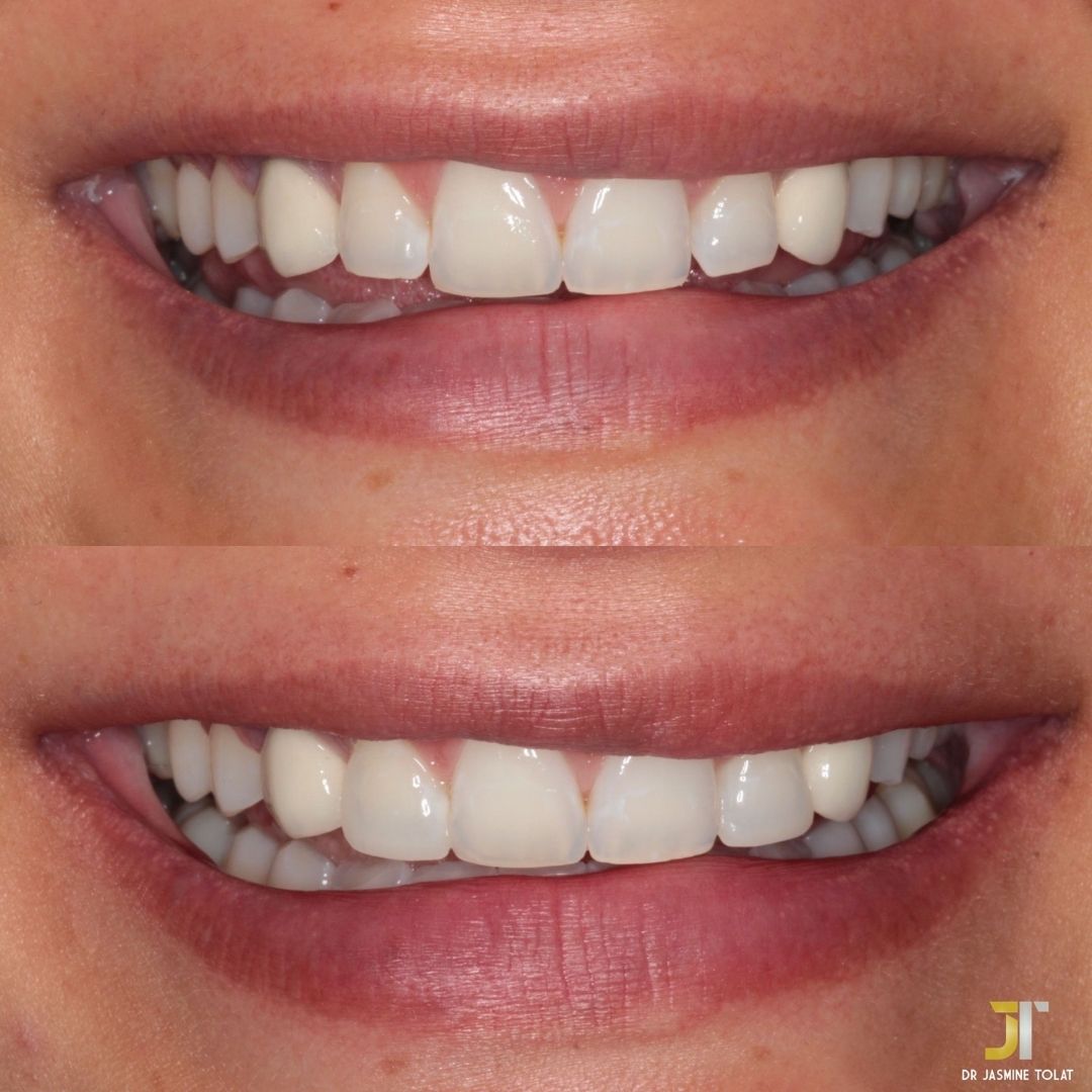Links Dental Practice | Request A Complimentary Consultation Before and after treatment at Links Dental Practice in Edinburgh