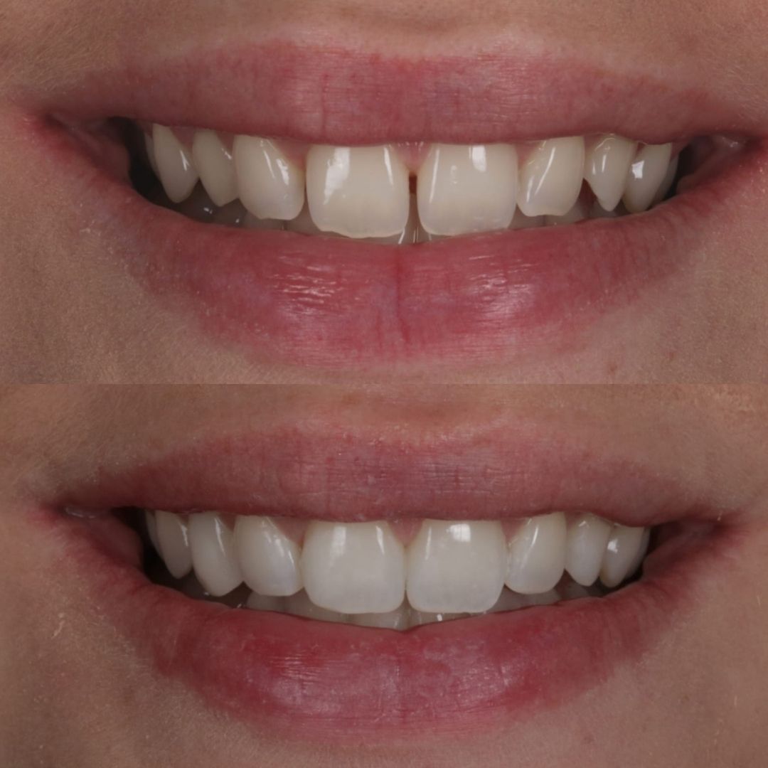 Links Dental Practice | Request A Complimentary Consultation Before and after treatment at Links Dental Practice in Edinburgh