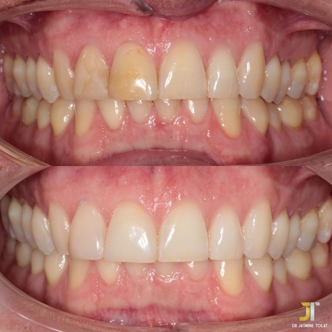 Links Dental Practice | Request A Complimentary Consultation Before and after treatment at Links Dental Practice in Edinburgh