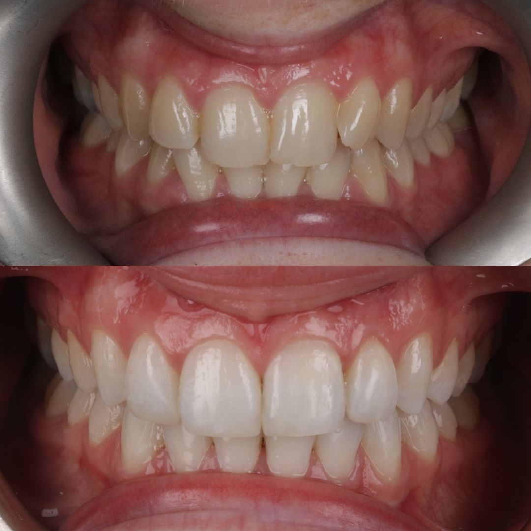 Links Dental Practice | Request A Complimentary Consultation Before and after treatment at Links Dental Practice in Edinburgh