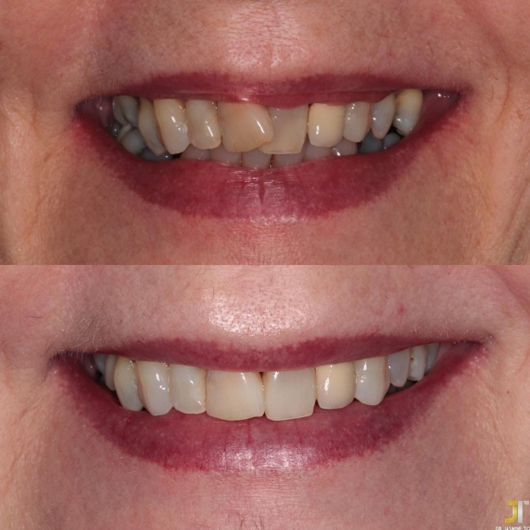 Links Dental Practice | Straight Teeth System Before and after treatment at Links Dental Practice in Edinburgh