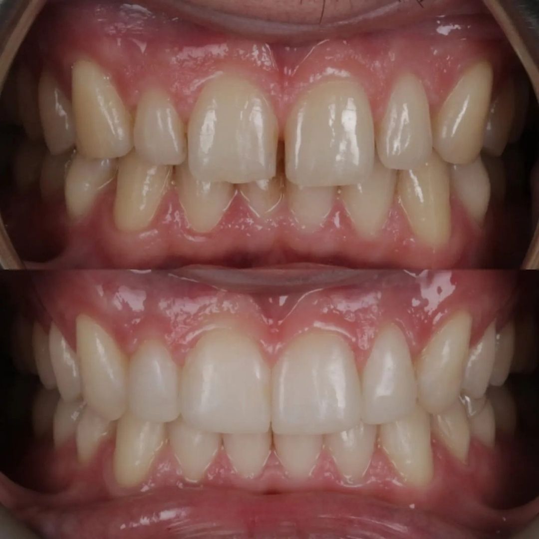 Links Dental Practice | Straight Teeth System Before and after treatment at Links Dental Practice in Edinburgh