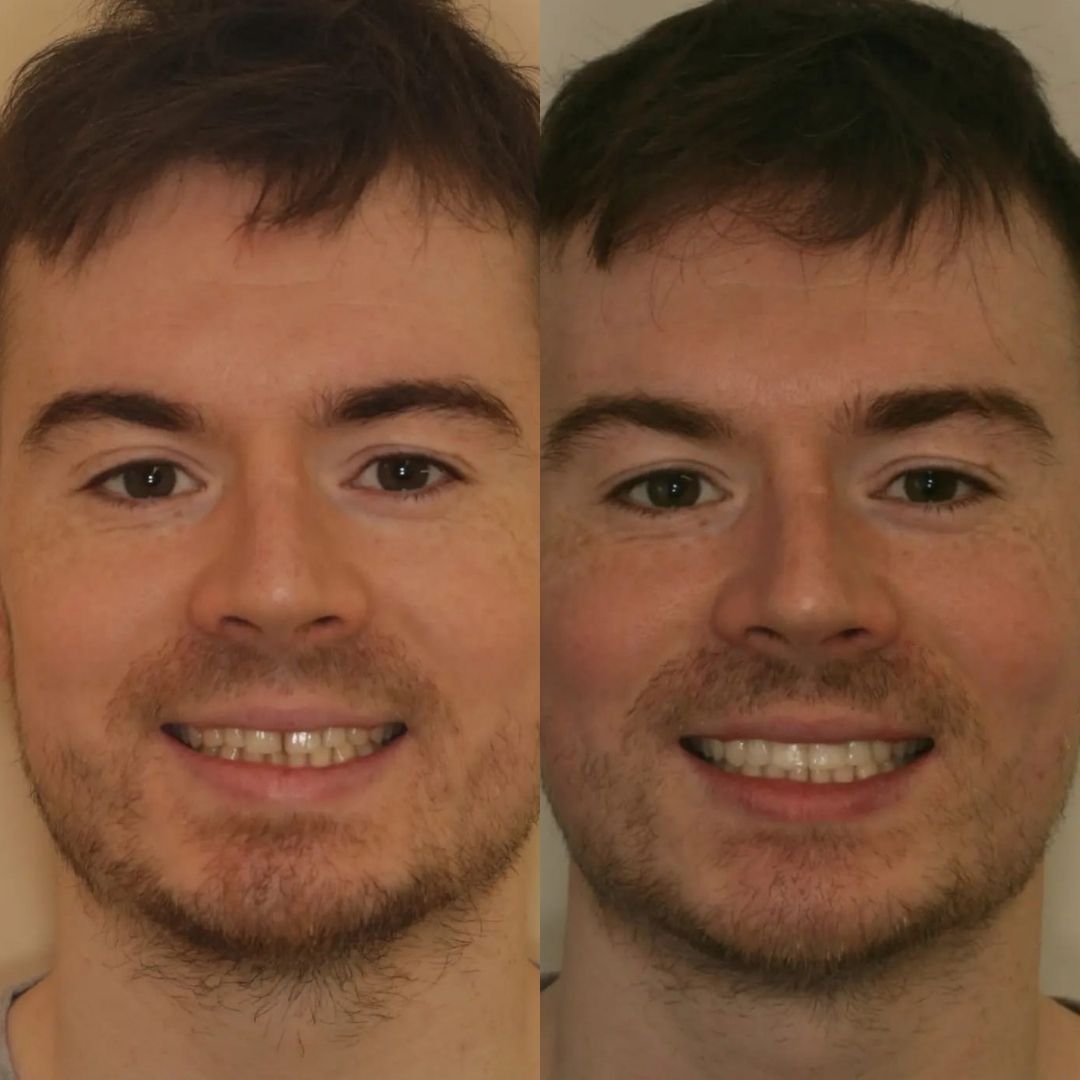 Links Dental Practice | Links Dental Practice in Edinburgh Before and after treatment
