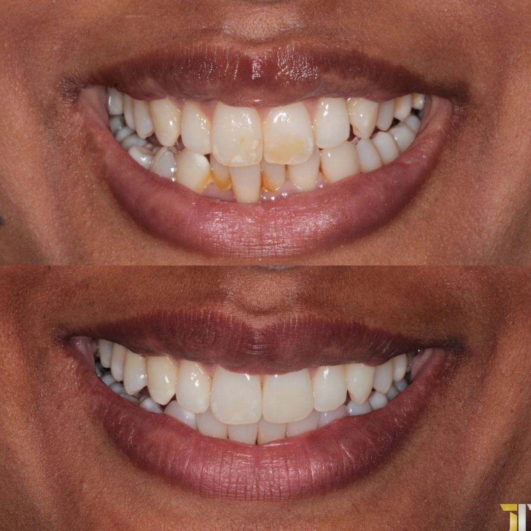 Links Dental Practice | Straight Teeth System Before and after treatment at Links Dental Practice in Edinburgh