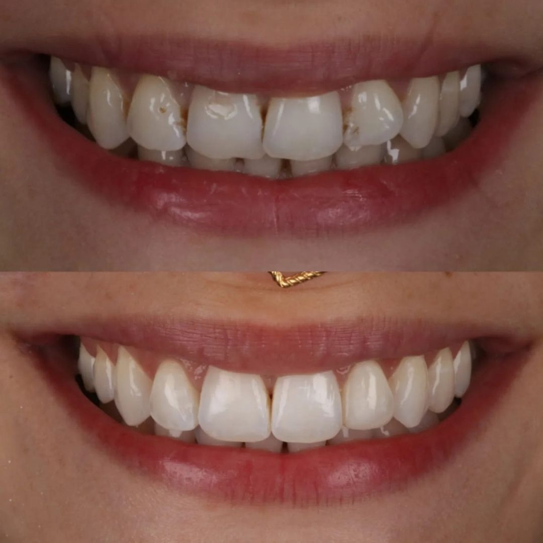 Links Dental Practice | Straight Teeth System Before and after treatment at Links Dental Practice in Edinburgh