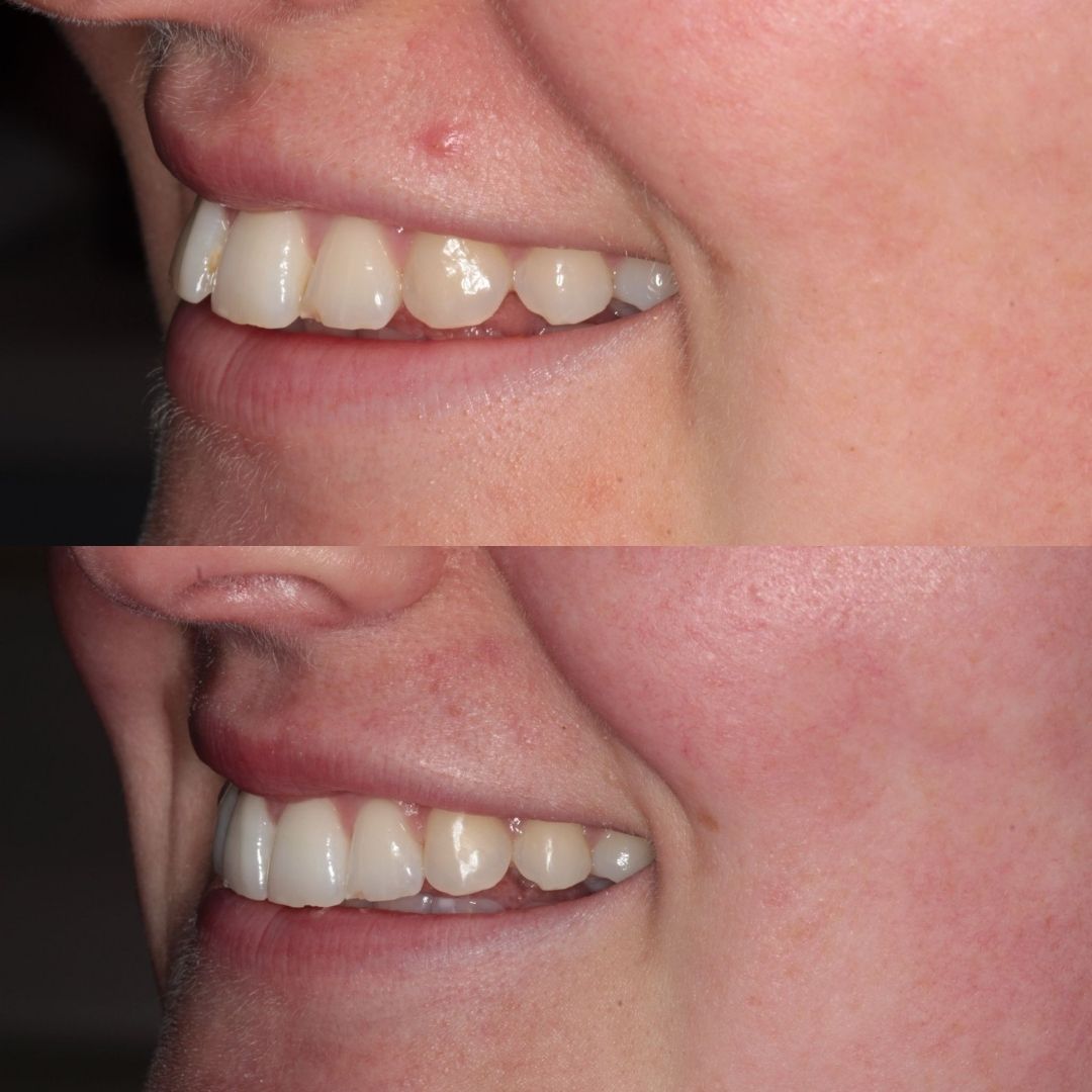 Links Dental Practice | Straight Teeth System Before and after treatment at Links Dental Practice in Edinburgh