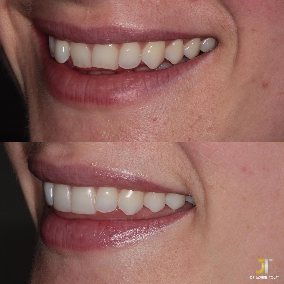 Links Dental Practice | Straight Teeth System Before and after treatment at Links Dental Practice in Edinburgh