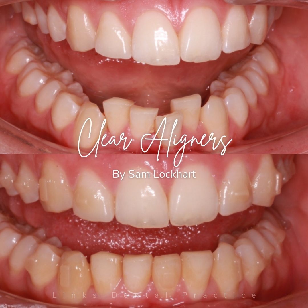 Links Dental Practice | Straight Teeth System Before and after treatment at Links Dental Practice in Edinburgh