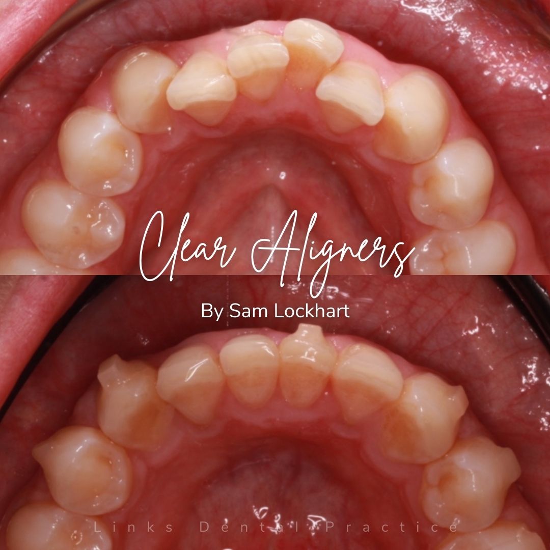 Links Dental Practice | Straight Teeth System Before and after treatment at Links Dental Practice in Edinburgh