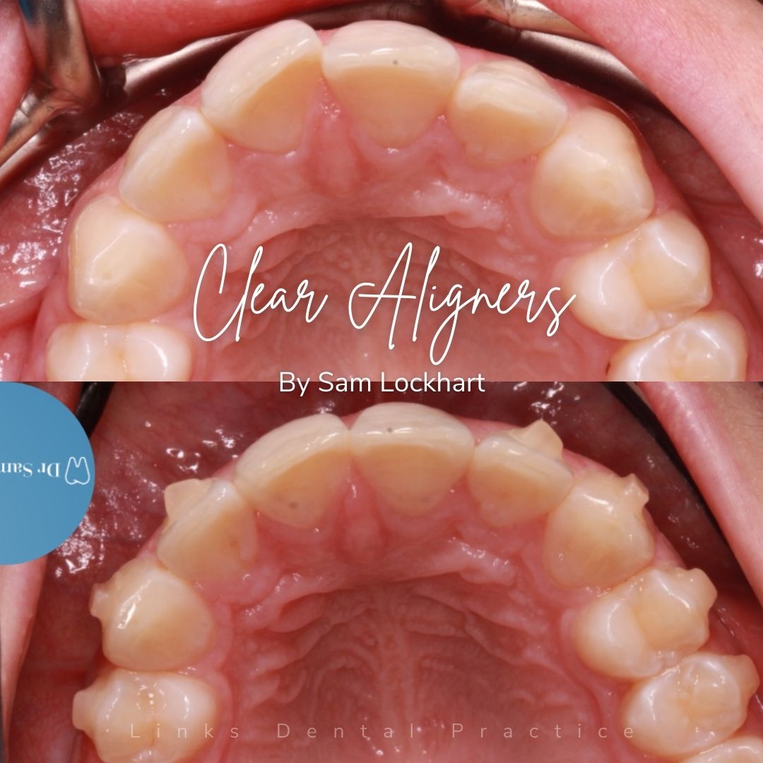 Links Dental Practice | Straight Teeth System Before and after treatment at Links Dental Practice in Edinburgh